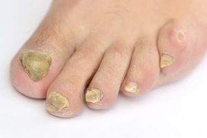 Schimmelinfecties van de nagels en hun behandeling met onycosolve